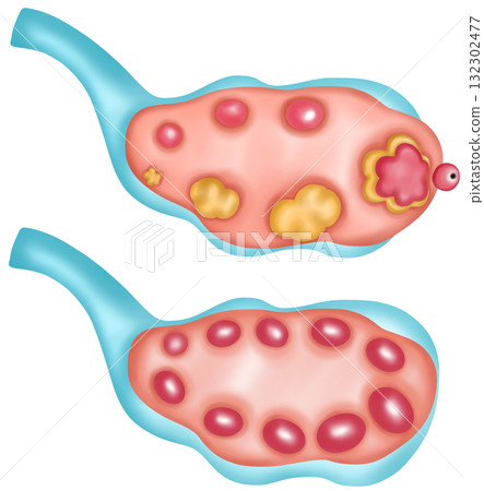 normal ovary an ovary with Polycystic Ovary Syndrome, PCOS normal ovary an ovary with Polycystic Ovary Syndrome, PCOS 132302477