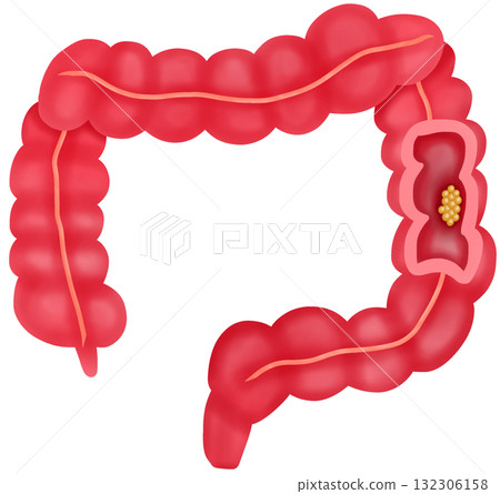 Anatomy of Colorectal Cancer, Hand-drawn Watercolor Illustration 132306158
