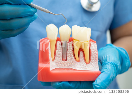 Dentist holding dental implant, artificial tooth roots into jaw, root canal of dental treatment, gum disease, teeth model for dentist. 132308296
