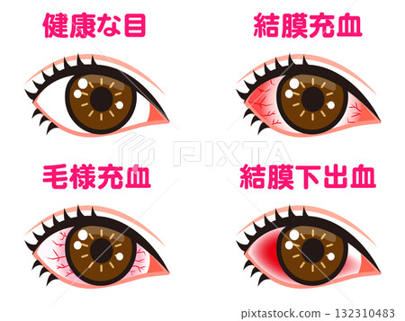 Illustration material set 2 of bloodshot eyes Illustration material set 2 of bloodshot eyes 132310483