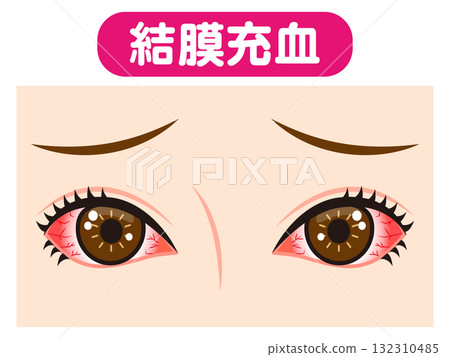 雙眼充血、結膜充血的插畫素材 132310485
