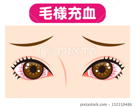 Illustration material of both eyes bloodshot due to ciliary congestion Illustration material of both eyes bloodshot due to ciliary congestion 132310486