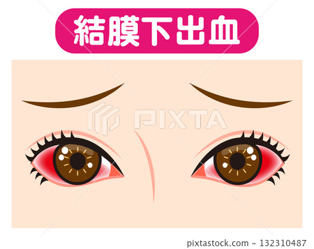 Illustration material of both eyes bloodshot due to subconjunctival hemorrhage Illustration material of both eyes bloodshot due to subconjunctival hemorrhage 132310487