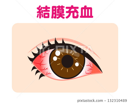 一隻眼睛結膜充血的插圖素材 132310489