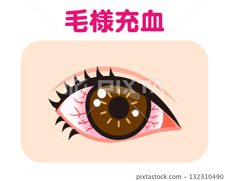 Illustration material of one eye bloodshot due to ciliary congestion Illustration material of one eye bloodshot due to ciliary congestion 132310490