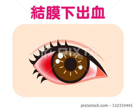 由於結膜下出血導致一隻眼睛充血的插圖素材 132310491