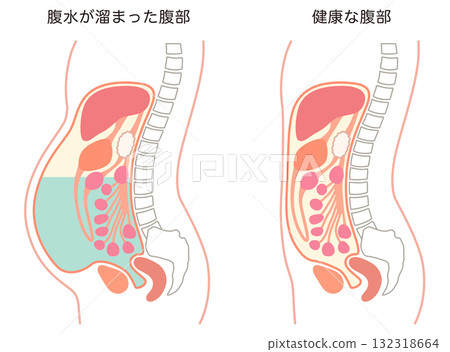 Abdomen with ascites and healthy abdomen 132318664