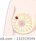 Breast Cancer Stage II (2nd Stage) Easy-to-understand illustration Breast Cancer Stage II (2nd Stage) Easy-to-understand illustration 132319344