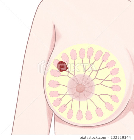 乳癌 II 期(第二階段)簡單易懂的插圖 乳癌 II 期(第二階段)簡單易懂的插圖 132319344