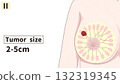 Breast Cancer Stage II (2nd Stage) Easy-to-understand English illustrations Breast Cancer Stage II (2nd Stage) Easy-to-understand English illustrations 132319345
