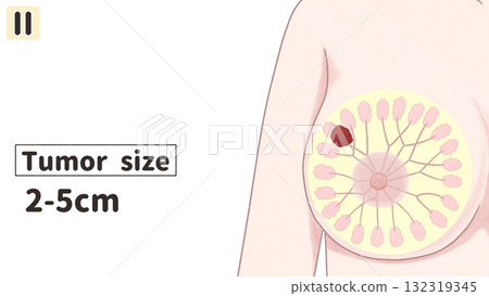 乳癌II期(第二期)簡單易懂的英文插圖 乳癌II期(第二期)簡單易懂的英文插圖 132319345