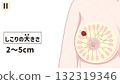 Breast Cancer Stage II (2nd Stage) Easy-to-understand Japanese illustrations Breast Cancer Stage II (2nd Stage) Easy-to-understand Japanese illustrations 132319346