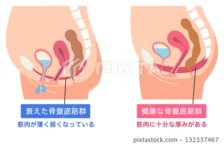 骨盆底肌肉衰弱和健康 132337467