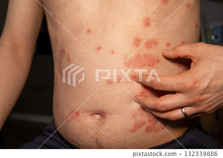 Psoriasis skin patches observed on the abdomen of an individual during a healthcare consultation 132339886