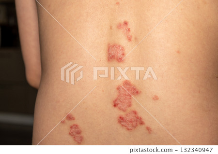 Psoriasis patches on the back showing red, itchy, and scaly skin indicating a chronic skin condition Psoriasis patches on the back showing red, itchy, and scaly skin indicating a chronic skin condition 132340947