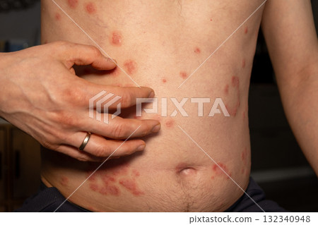 Skin condition experiencing psoriasis flare up with red patches on abdomen area Skin condition experiencing psoriasis flare up with red patches on abdomen area 132340948