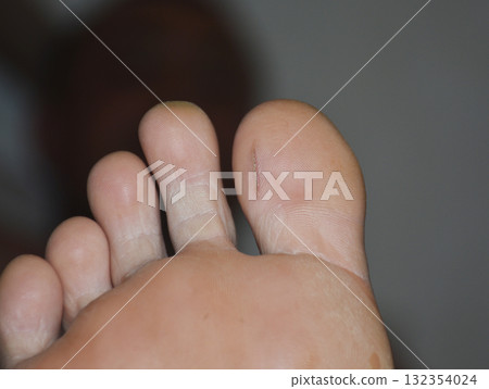 I have a small cut on my toe. The skin around the wound is swollen and inflamed 132354024