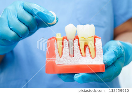 Doctor hold dental implant, artificial tooth roots into jaw, root canal of dental treatment, gum disease, teeth model for dentist studying about dentistry. 132359910