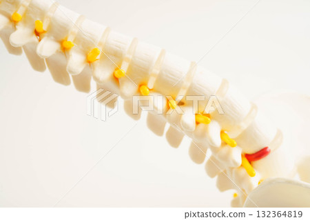 Spinal nerve and bone, Lumbar spine displaced herniated disc fragment, Model for treatment medical in the orthopedic department. 132364819