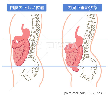 內臟下垂:內臟器官下垂的一種狀況 內臟下垂:內臟器官下垂的一種狀況 132372398