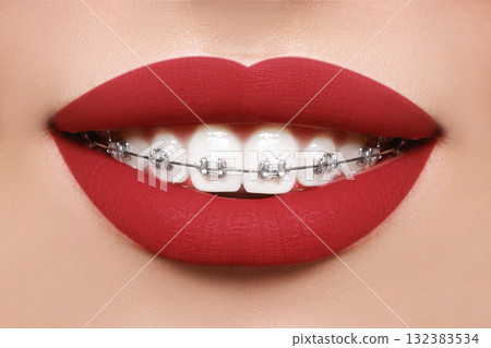 Beautiful white teeth with braces. Dental care photo. Woman smile with ortodontic accessories. Orthodontics treatment Beautiful white teeth with braces. Dental care photo. Woman smile with ortodontic accessories. Orthodontics treatment 132383534