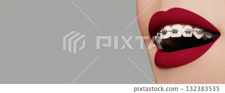 Beautiful white teeth with braces. Dental care photo. Woman smile with ortodontic accessories. Red lipstick on lips Beautiful white teeth with braces. Dental care photo. Woman smile with ortodontic accessories. Red lipstick on lips 132383535