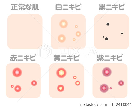 各種痤瘡病例和類型插圖素材套裝4 132418044