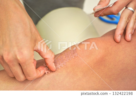 Skin coloured kinesiology grid tape applied on knee of patient, closeup detail 132422198