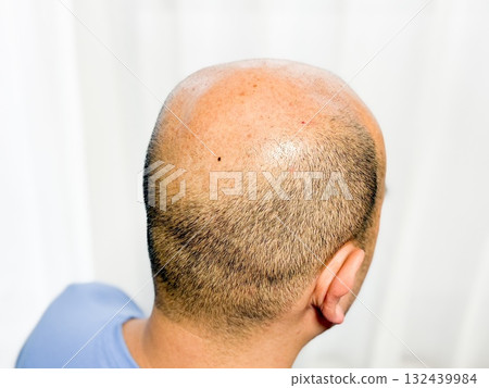 Middle-aged man with thinning hair (U-shaped hairline) 132439984