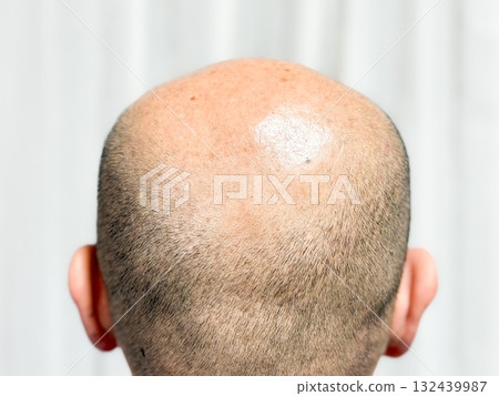 一位三十多歲、頭髮稀疏的男子 一位三十多歲、頭髮稀疏的男子 132439987