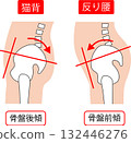 因駝背導致的骨盆前傾和因駝背導致的骨盆後傾 132446276