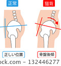 由於駝背和正常骨盆位置導致骨盆後傾 132446277