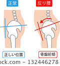 因脊椎前凸和正常骨盆位置導致的骨盆前傾 132446278
