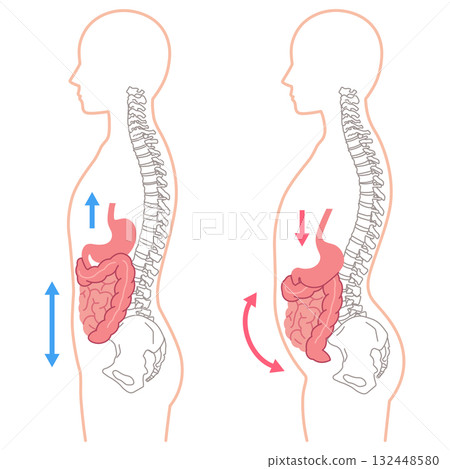 內臟下垂:內臟器官下垂的一種狀況 內臟下垂:內臟器官下垂的一種狀況 132448580
