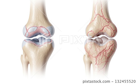 Healthy vs Osteoporotic Bone Microstructure 132455520