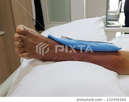 Purpura caused by cancer on leg is side effect of chemotherapy or caused by cancer cells interfering with platelet production in the bone marrow. 132456169