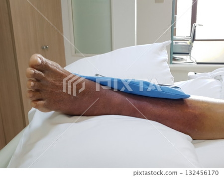 Purpura caused by cancer on leg is side effect of chemotherapy or caused by cancer cells interfering with platelet production in the bone marrow. 132456170