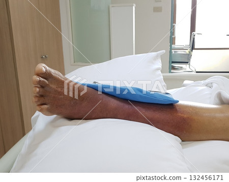 Purpura caused by cancer on leg is side effect of chemotherapy or caused by cancer cells interfering with platelet production in the bone marrow. 132456171