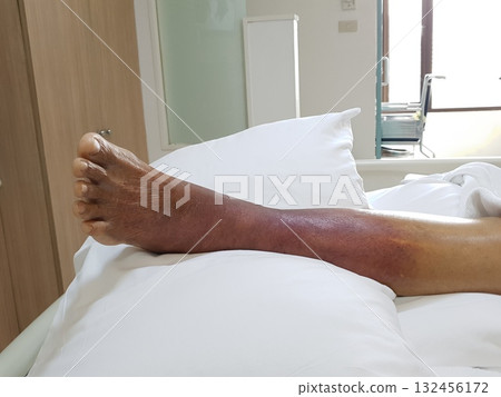 Purpura caused by cancer on leg is side effect of chemotherapy or caused by cancer cells interfering with platelet production in the bone marrow. 132456172