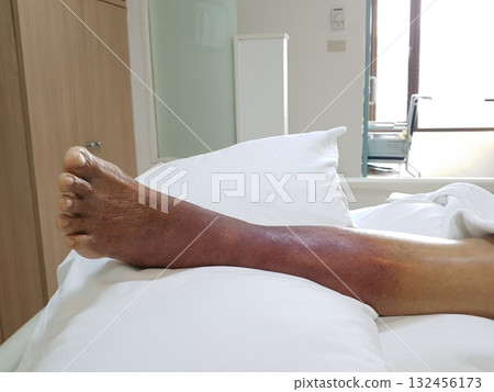 Purpura caused by cancer on leg is side effect of chemotherapy or caused by cancer cells interfering with platelet production in the bone marrow. 132456173