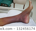 Purpura caused by cancer on leg is side effect of chemotherapy or caused by cancer cells interfering with platelet production in the bone marrow. 132456174