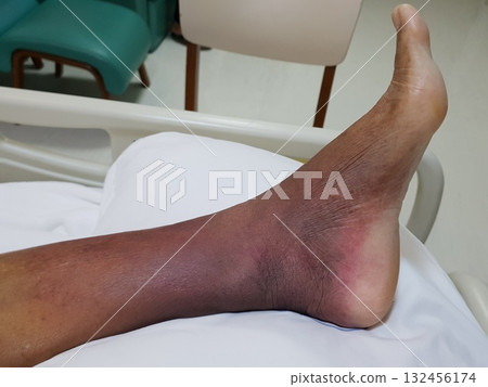 Purpura caused by cancer on leg is side effect of chemotherapy or caused by cancer cells interfering with platelet production in the bone marrow. 132456174