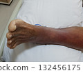 Purpura caused by cancer on leg is side effect of chemotherapy or caused by cancer cells interfering with platelet production in the bone marrow. 132456175