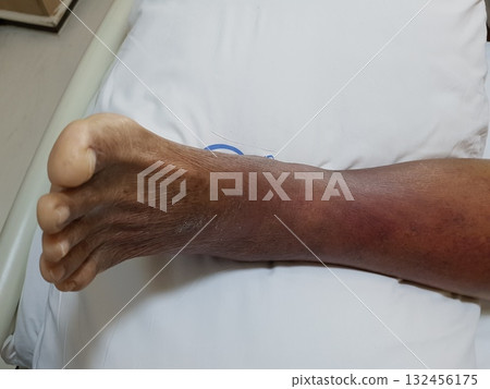 Purpura caused by cancer on leg is side effect of chemotherapy or caused by cancer cells interfering with platelet production in the bone marrow. 132456175