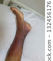 Purpura caused by cancer on leg is side effect of chemotherapy or caused by cancer cells interfering with platelet production in the bone marrow. 132456176
