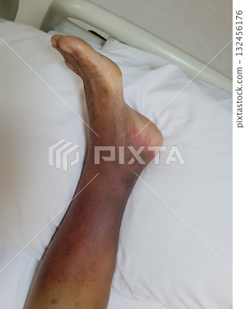 Purpura caused by cancer on leg is side effect of chemotherapy or caused by cancer cells interfering with platelet production in the bone marrow. 132456176