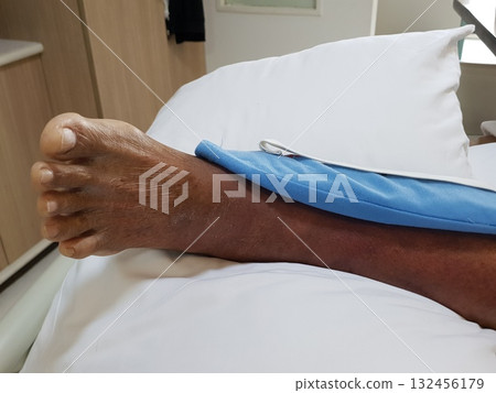 Purpura caused by cancer on leg is side effect of chemotherapy or caused by cancer cells interfering with platelet production in the bone marrow. 132456179