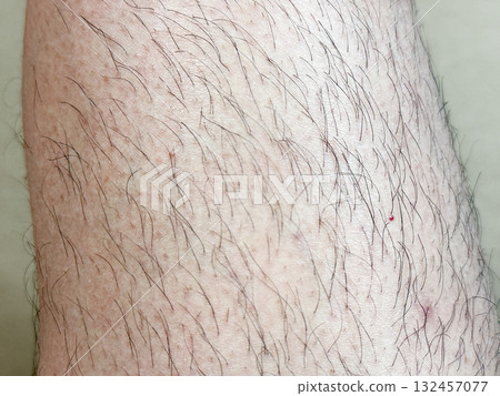 Leg hair, unwanted hair Leg hair, unwanted hair 132457077