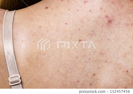 Woman with skin problem acne on back 132457456