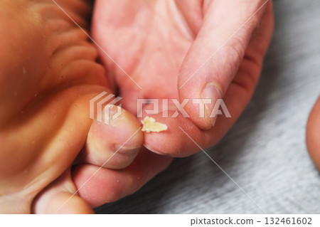 Removal of dry skin from the toes. Removal of corns from the feet 132461602